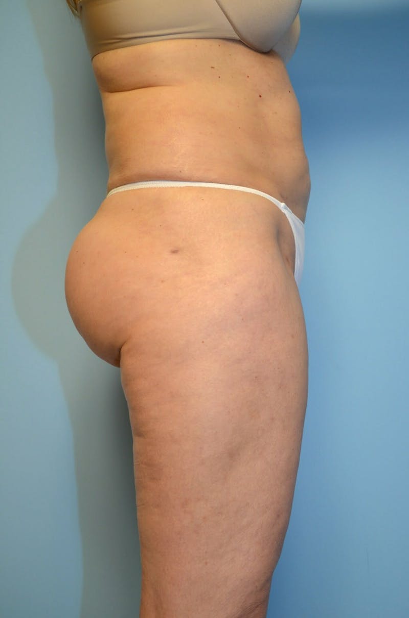 Liposuction Before & After Gallery - Patient 986940 - Image 6
