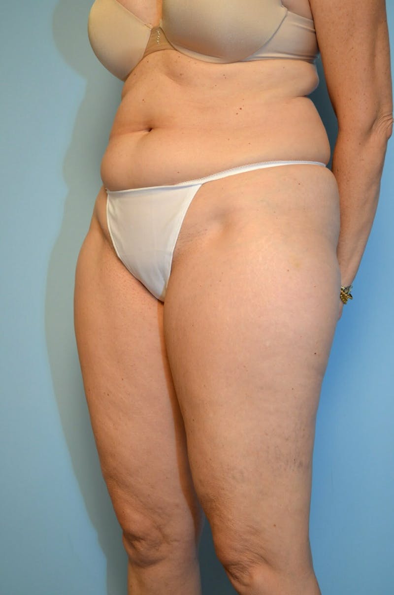 Liposuction Before & After Gallery - Patient 986940 - Image 7