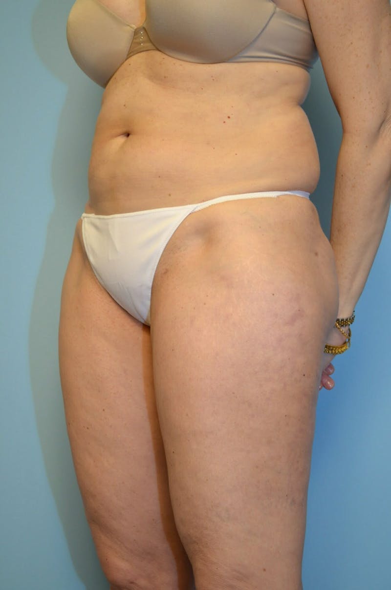 Liposuction Before & After Gallery - Patient 986940 - Image 8