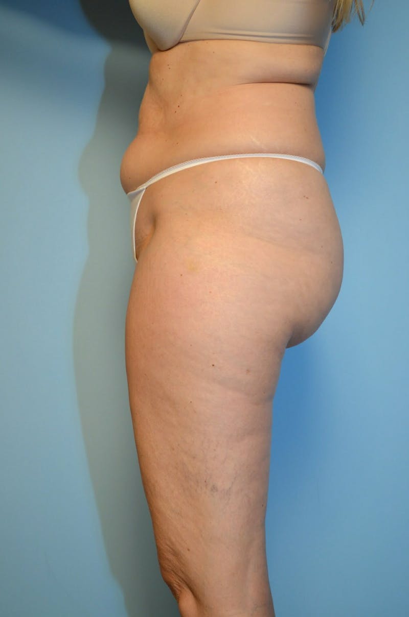 Liposuction Before & After Gallery - Patient 986940 - Image 9