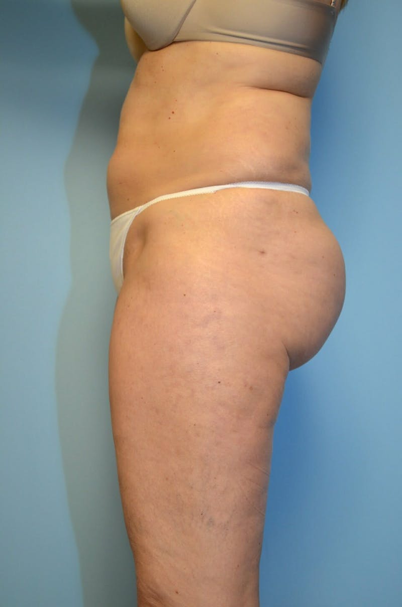 Liposuction Before & After Gallery - Patient 986940 - Image 10