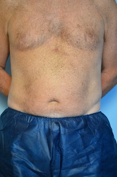 Male Procedures by Dr. Hess Before & After Gallery - Patient 245531 - Image 1