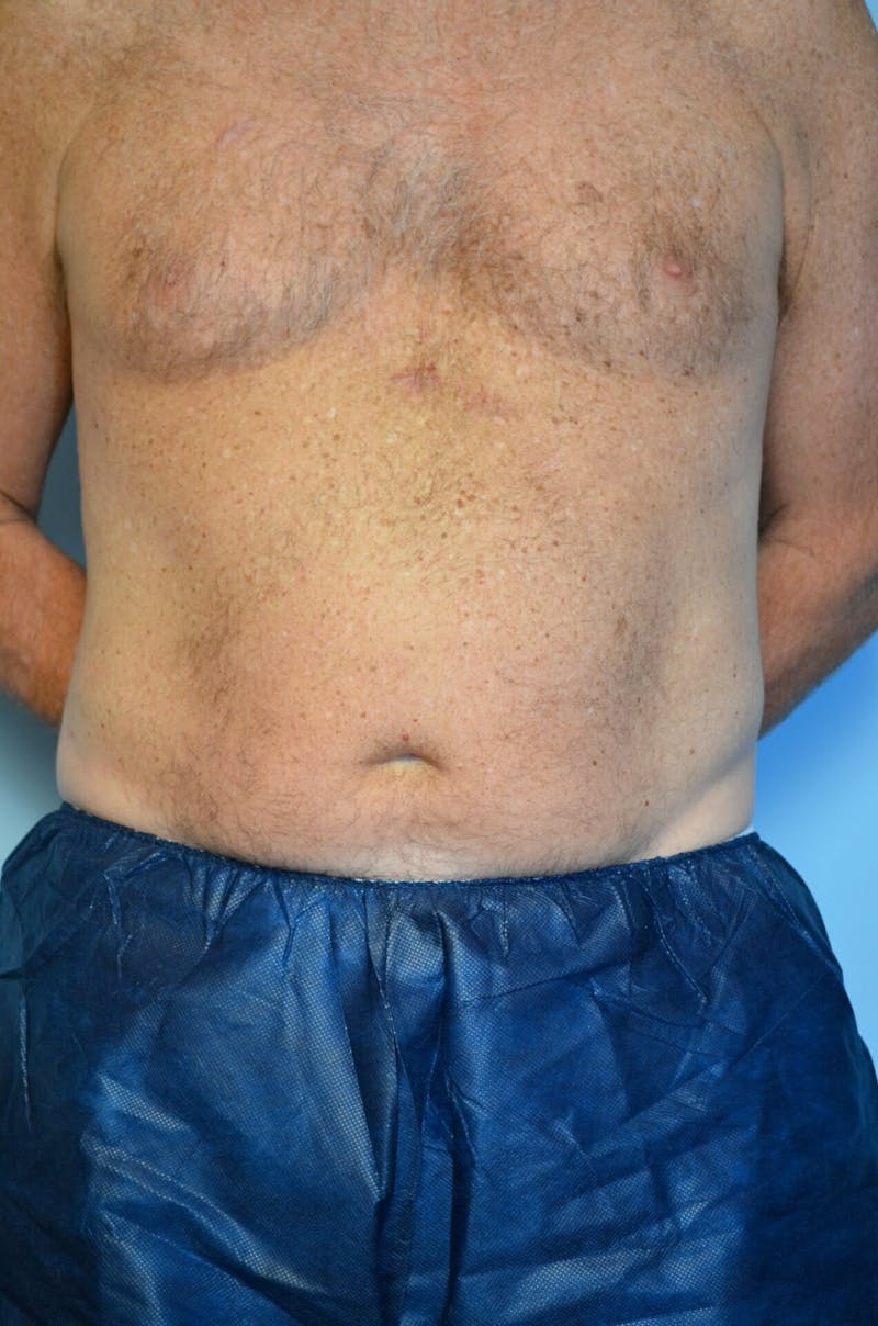 Male Procedures by Dr. Hess Before & After Gallery - Patient 245531 - Image 1
