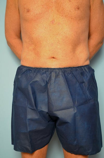 Male Procedures by Dr. Hess Before & After Gallery - Patient 245531 - Image 2