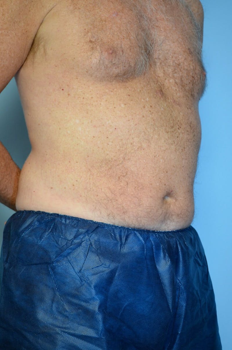 Male Procedures by Dr. Hess Before & After Gallery - Patient 245531 - Image 3
