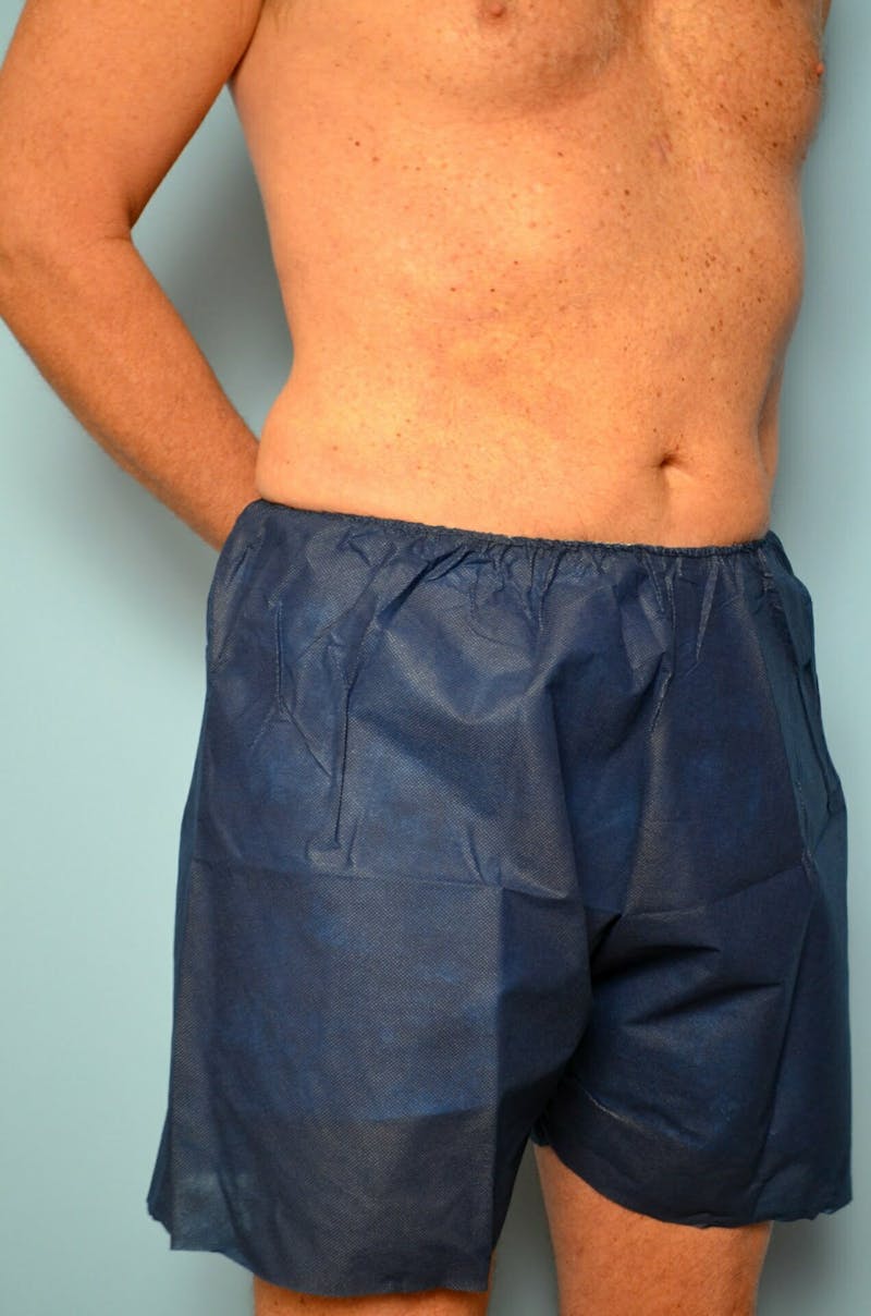 Male Procedures by Dr. Hess Before & After Gallery - Patient 245531 - Image 4