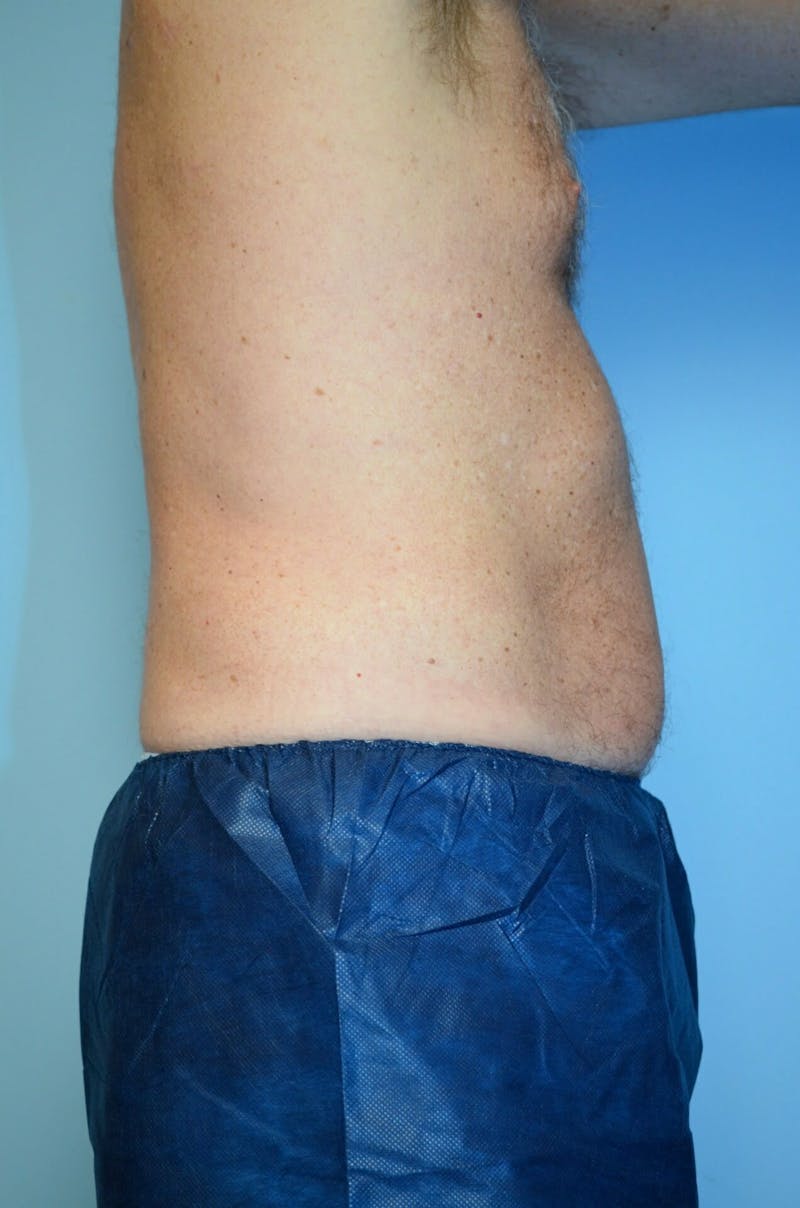 Male Procedures by Dr. Hess Before & After Gallery - Patient 245531 - Image 5
