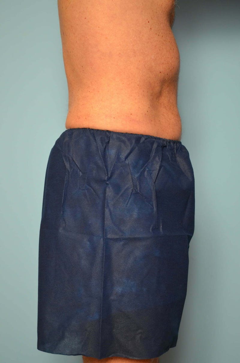 Male Procedures by Dr. Hess Before & After Gallery - Patient 245531 - Image 6