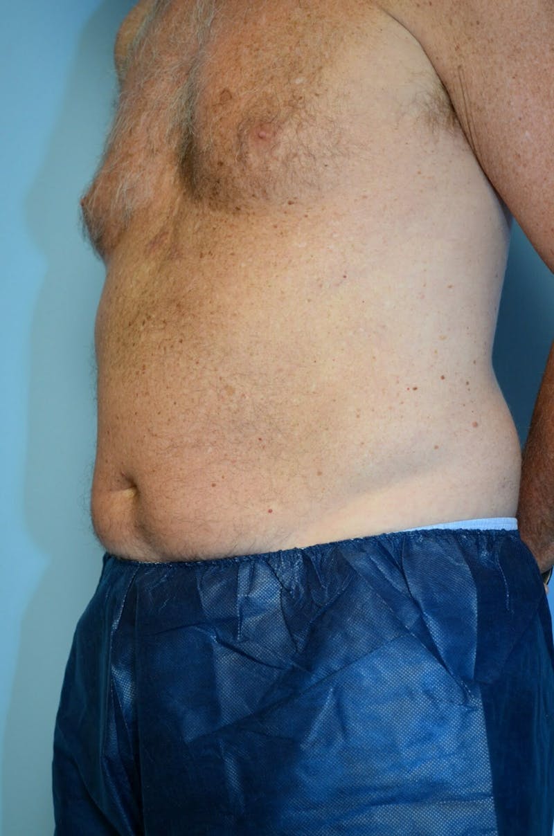 Male Procedures by Dr. Hess Before & After Gallery - Patient 245531 - Image 7
