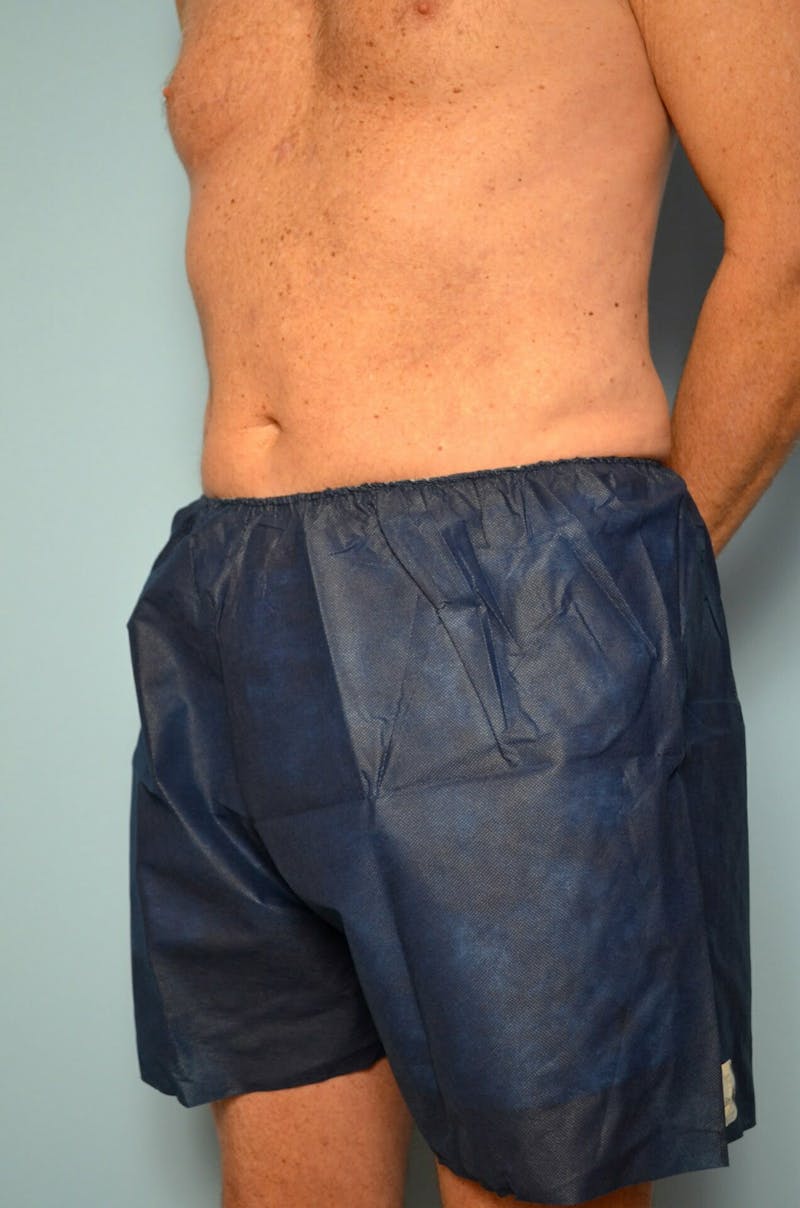 Male Procedures by Dr. Hess Before & After Gallery - Patient 245531 - Image 8