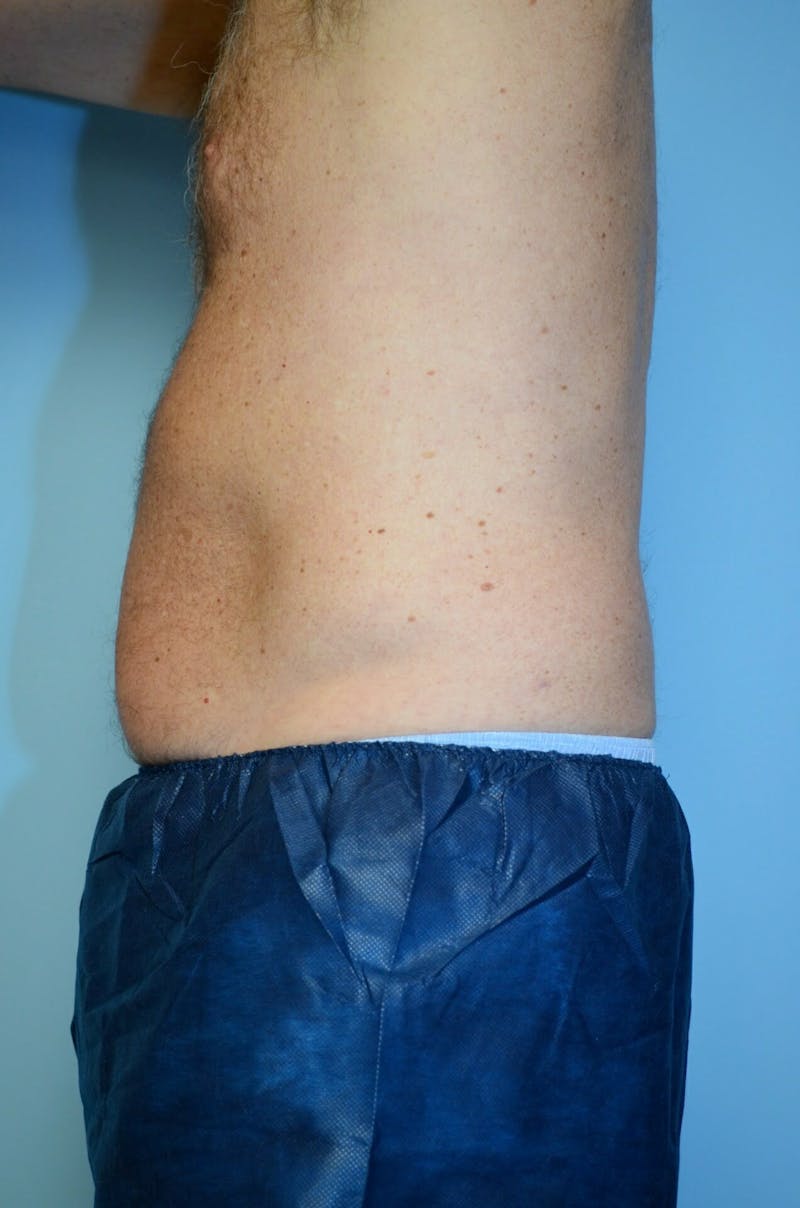 Male Procedures by Dr. Hess Before & After Gallery - Patient 245531 - Image 9