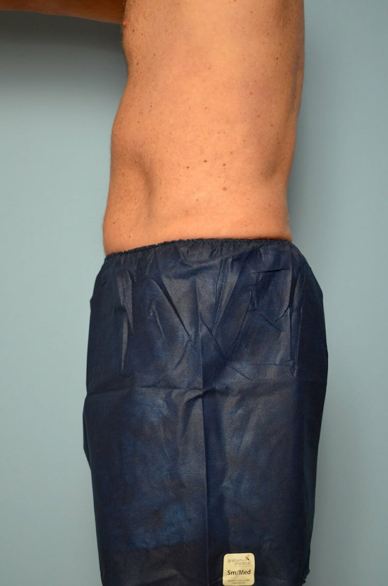 Male Procedures by Dr. Hess Before & After Gallery - Patient 245531 - Image 10