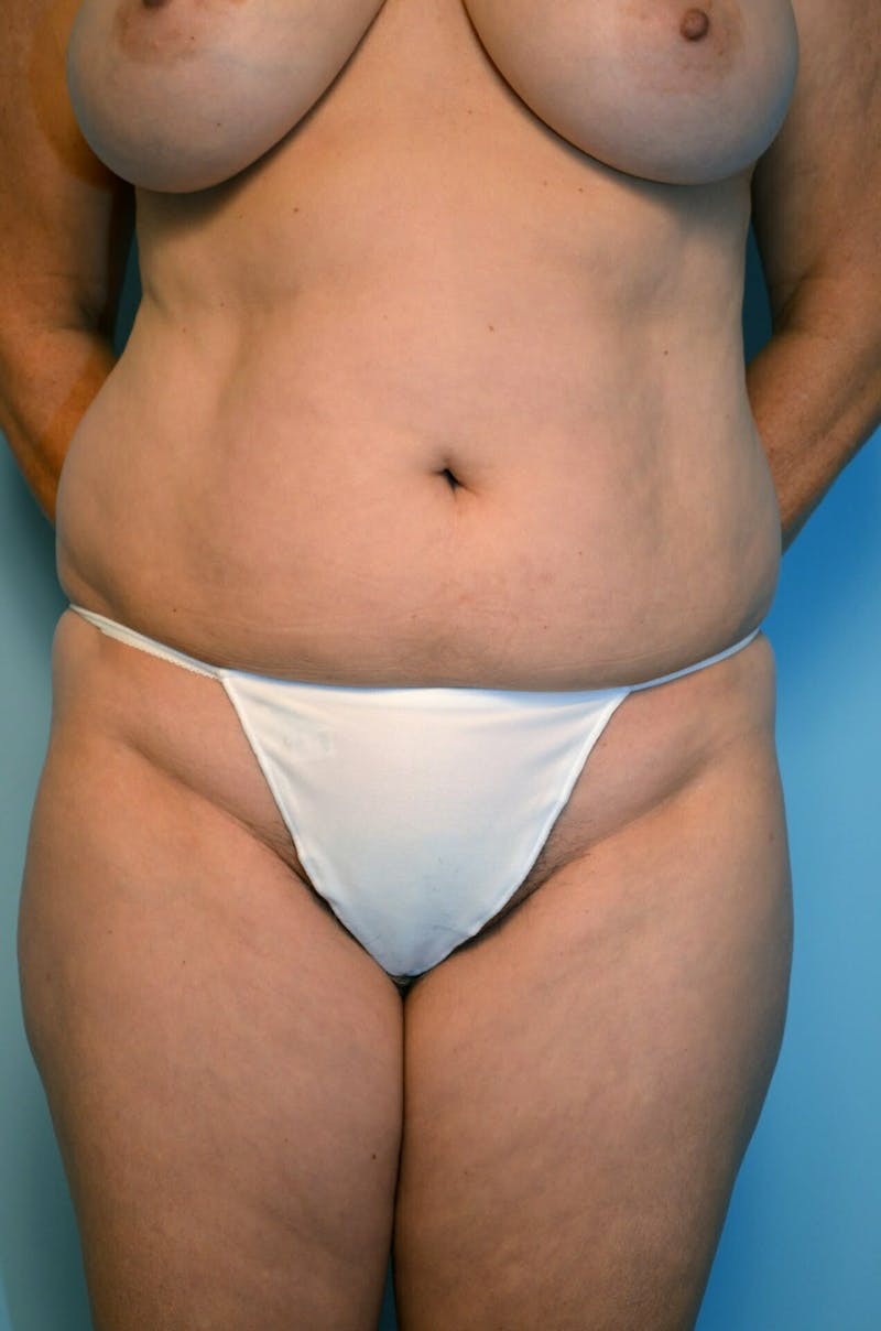 Liposuction Before & After Gallery - Patient 138206 - Image 1