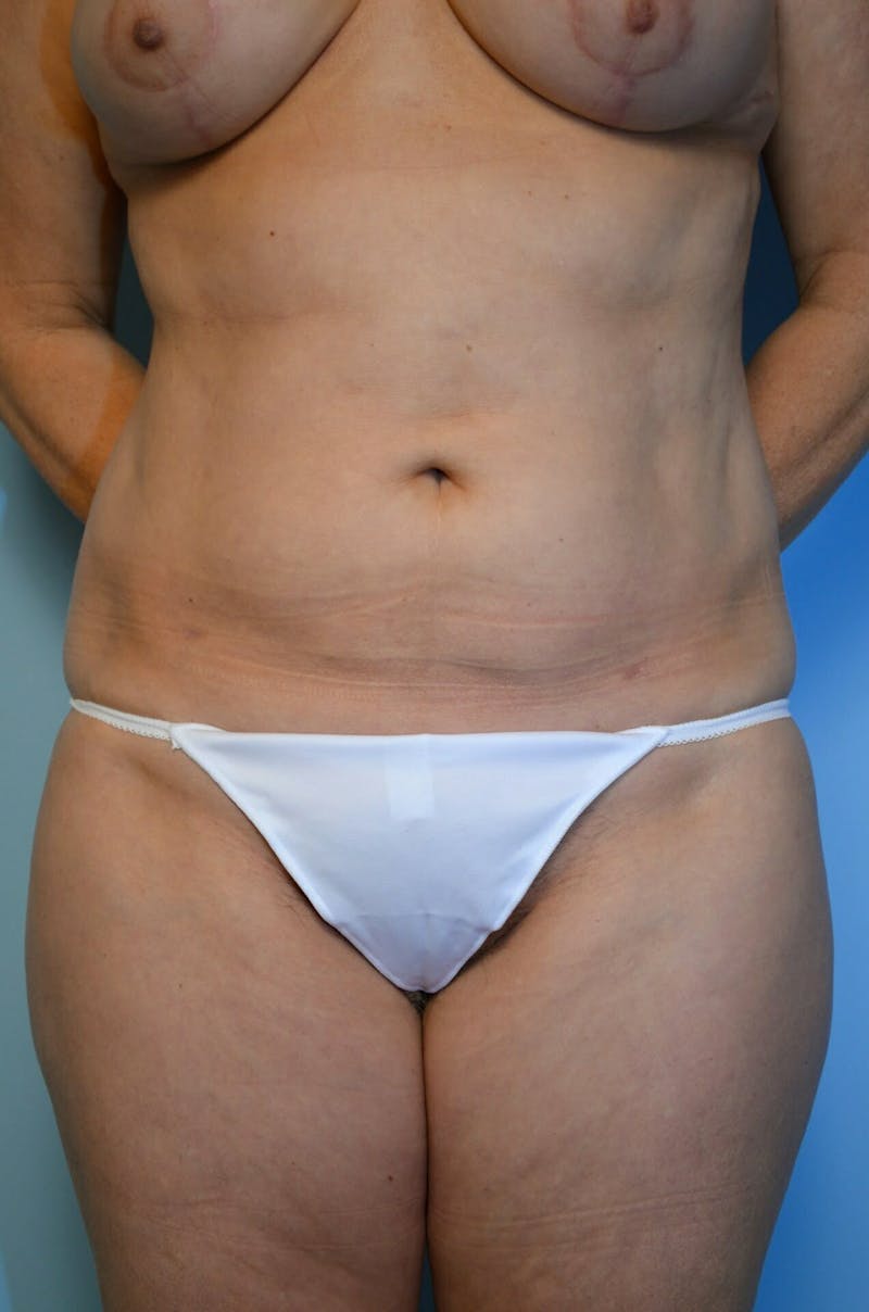 Liposuction Before & After Gallery - Patient 138206 - Image 2