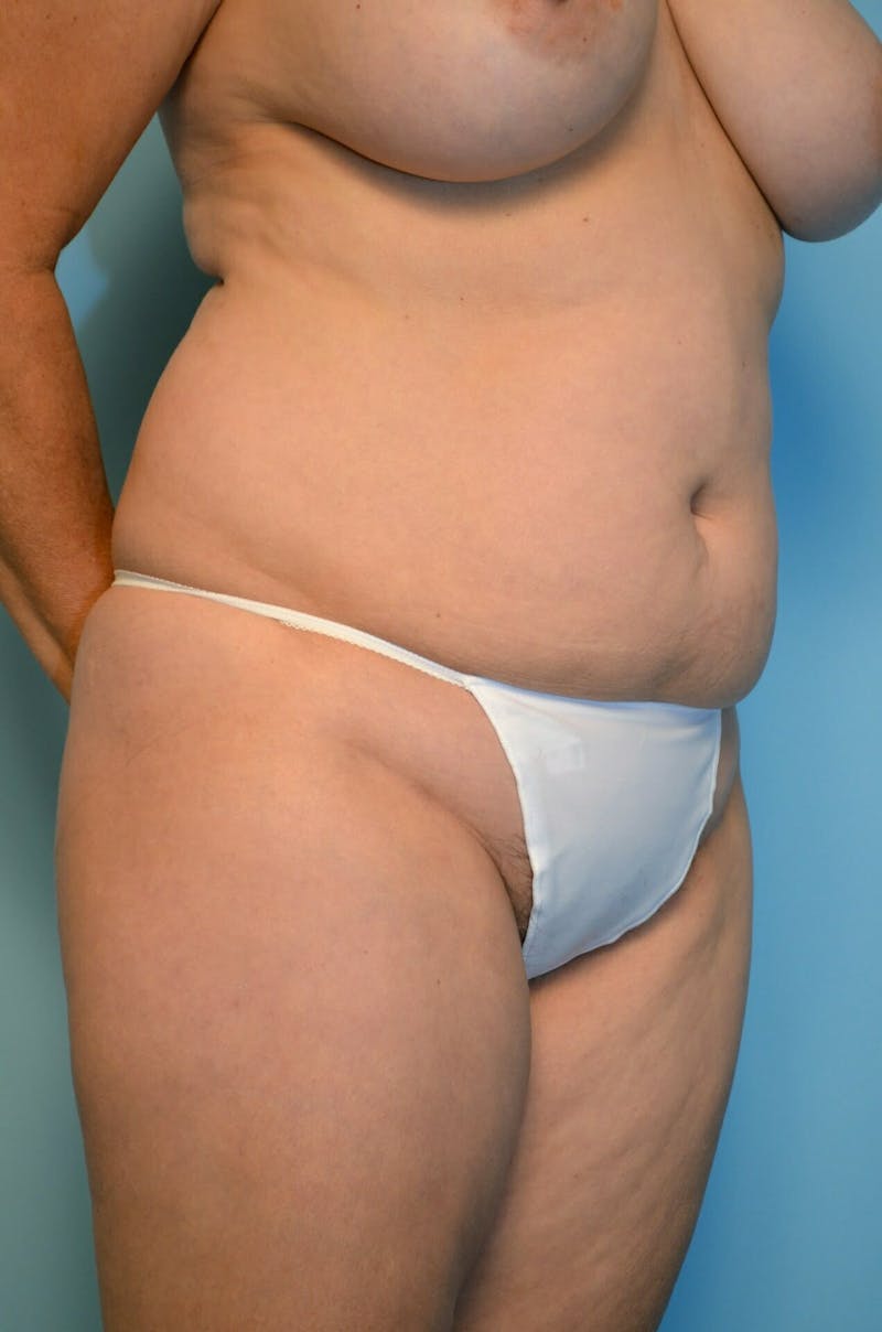 Liposuction Before & After Gallery - Patient 138206 - Image 3