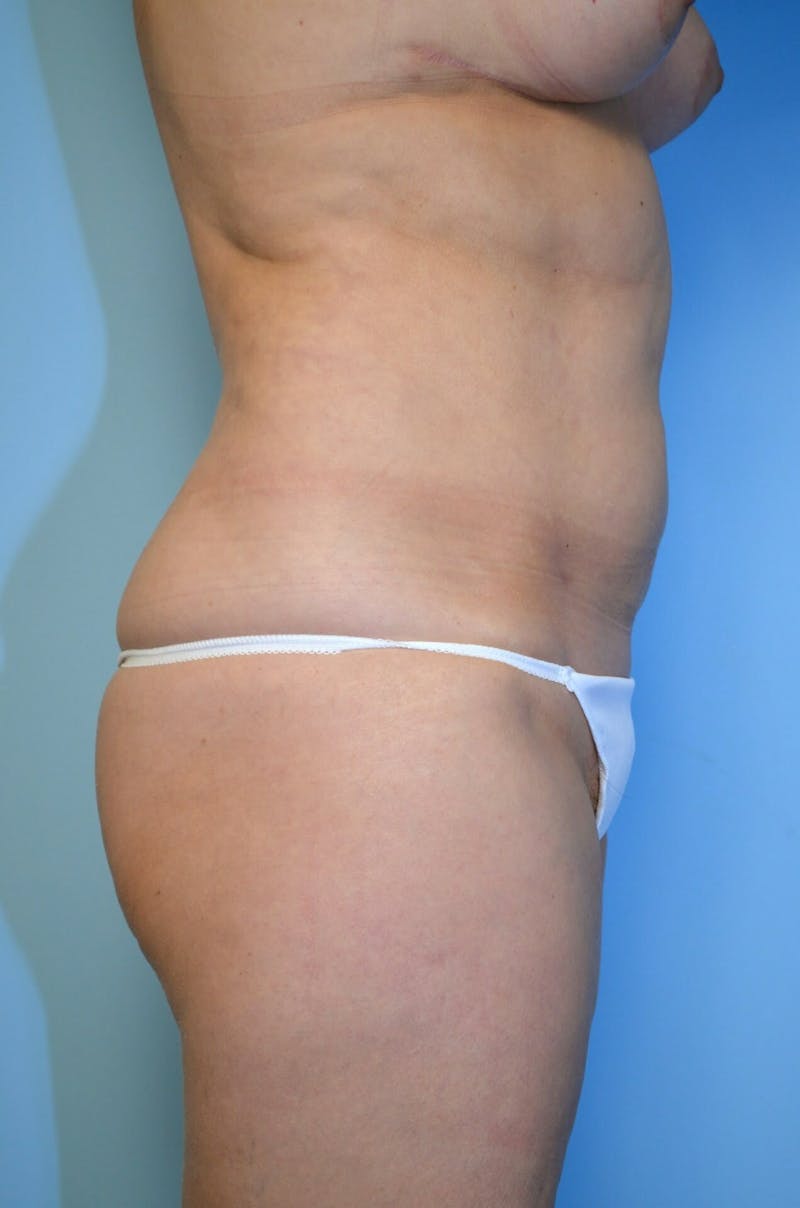 Liposuction Before & After Gallery - Patient 138206 - Image 6