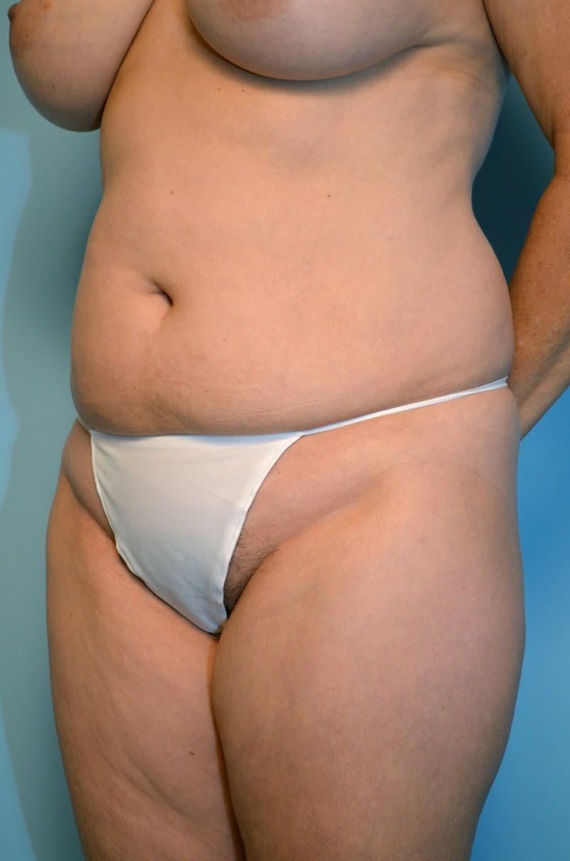 Liposuction Before & After Gallery - Patient 138206 - Image 7