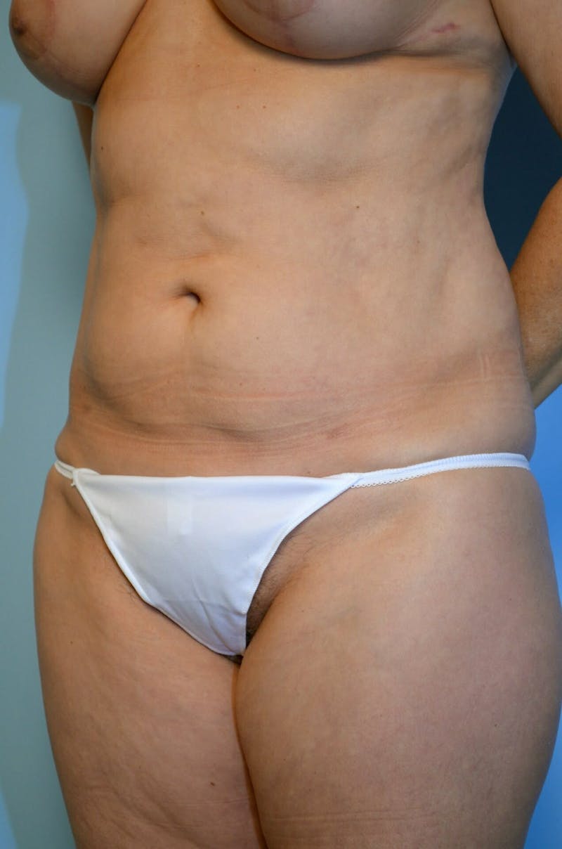 Liposuction Before & After Gallery - Patient 138206 - Image 8
