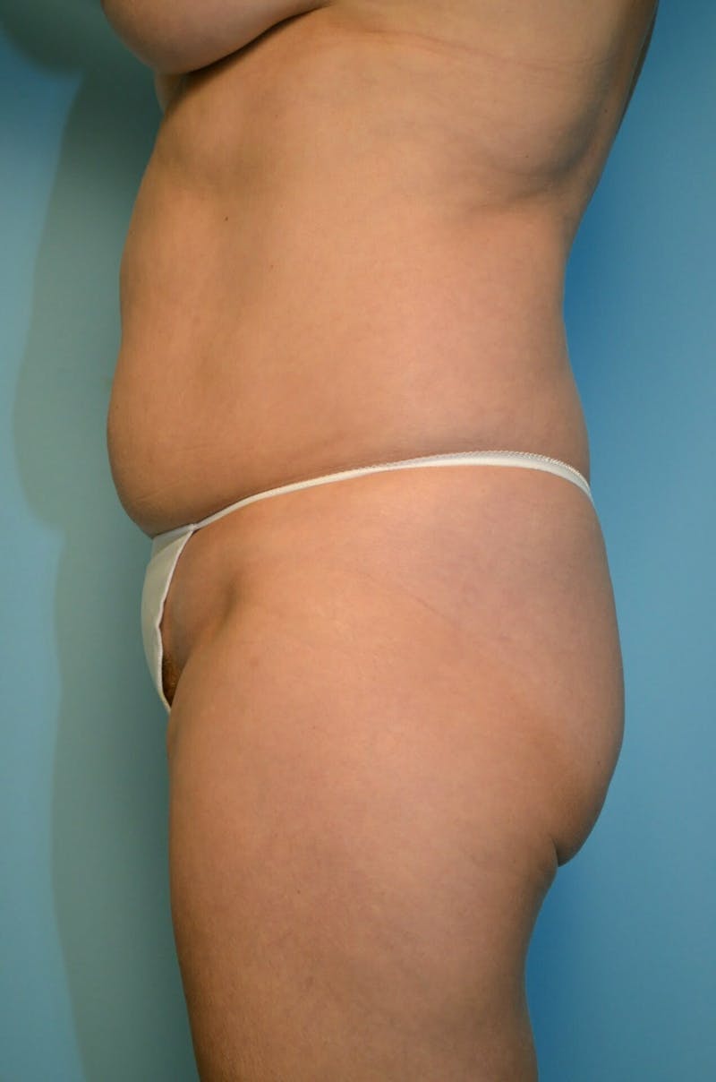 Liposuction Before & After Gallery - Patient 138206 - Image 9