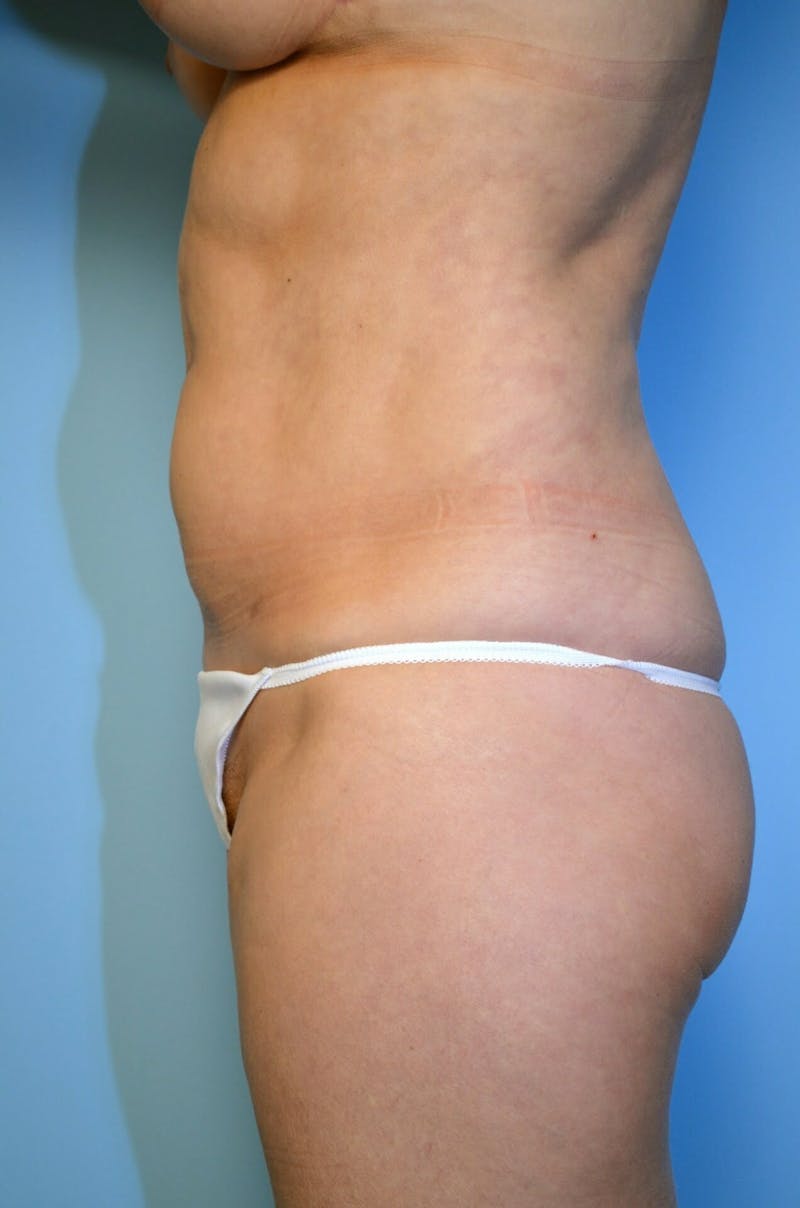 Liposuction Before & After Gallery - Patient 138206 - Image 10