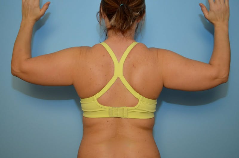 Liposuction Before & After Gallery - Patient 360124 - Image 1