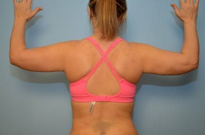 Liposuction Before & After Gallery - Patient 360124 - Image 2