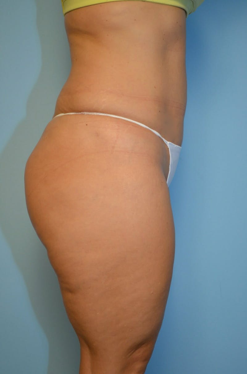 Liposuction Before & After Gallery - Patient 360124 - Image 7