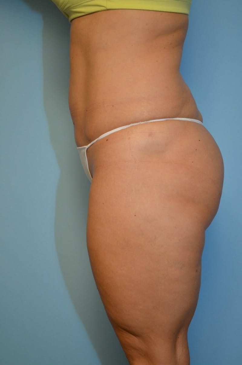 Liposuction Before & After Gallery - Patient 360124 - Image 11