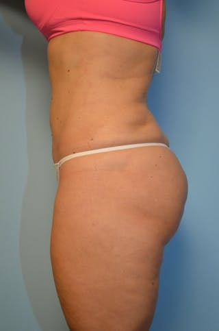 Liposuction Before & After Gallery - Patient 360124 - Image 12