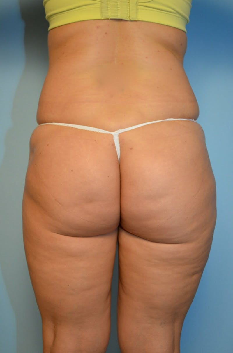Liposuction Before & After Gallery - Patient 360124 - Image 13