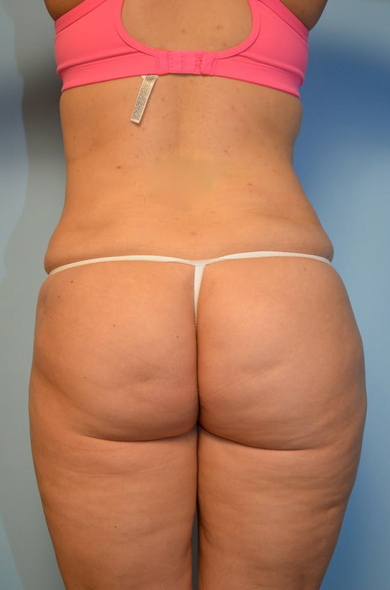 Liposuction Before & After Gallery - Patient 360124 - Image 14