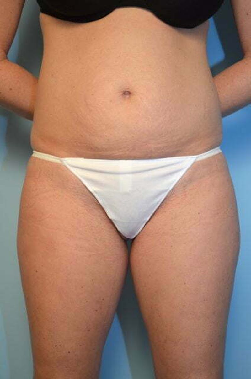 Umbilical Float Tummy Tuck Before & After Gallery - Patient 859967 - Image 1
