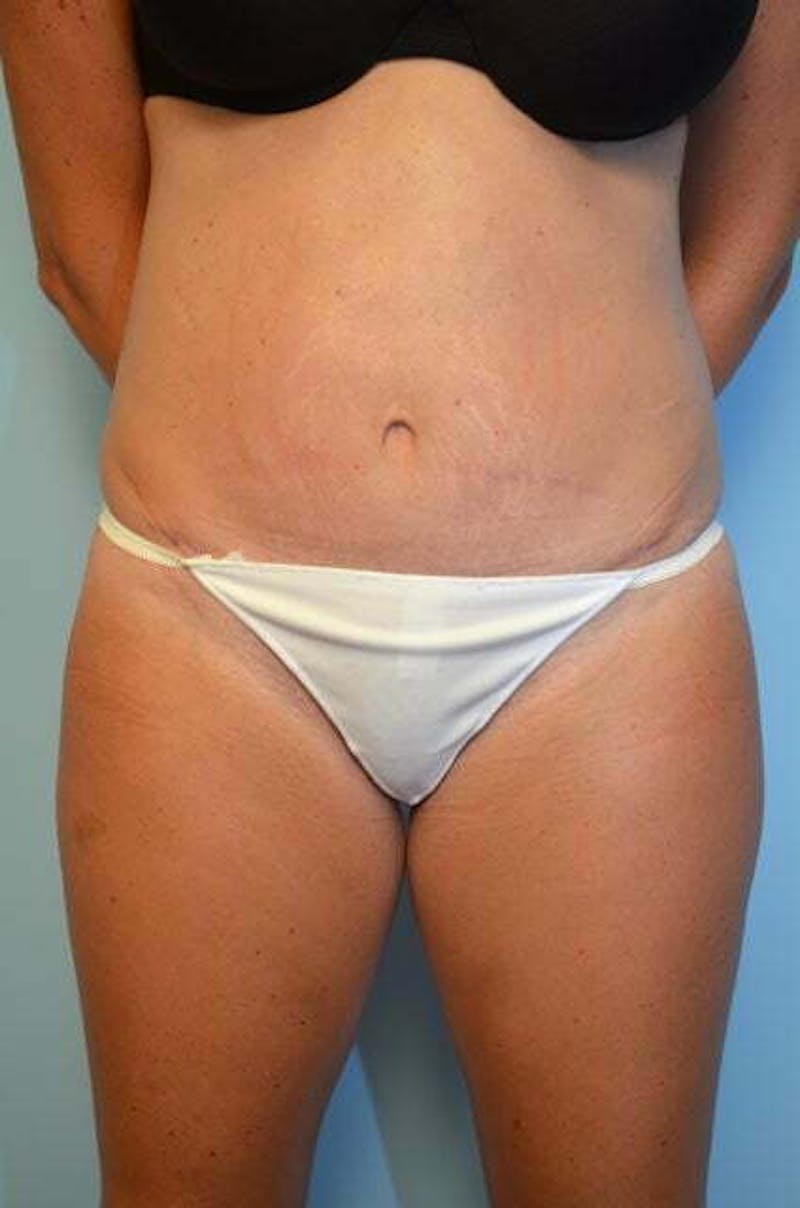 Umbilical Float Tummy Tuck Before & After Gallery - Patient 859967 - Image 2