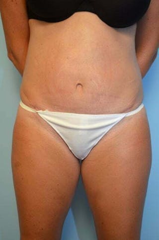 Liposuction Before & After Gallery - Patient 286969 - Image 2