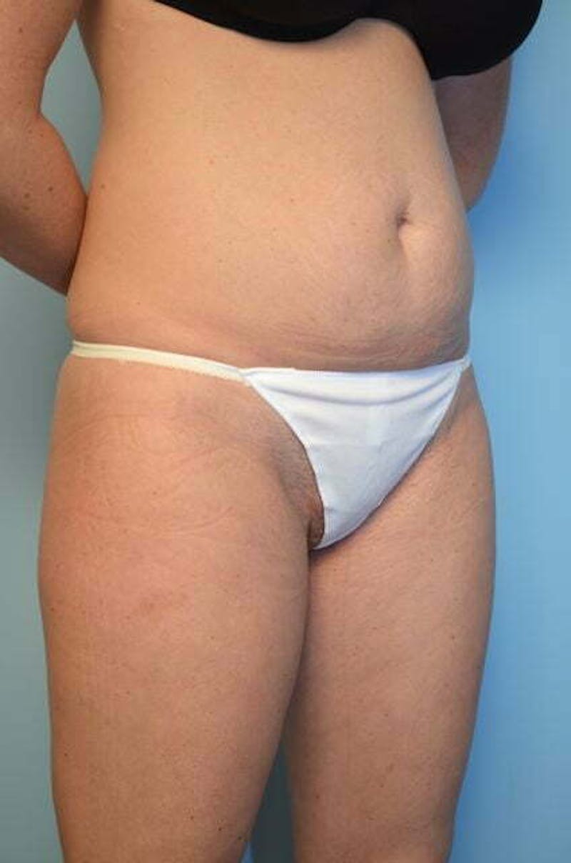 Umbilical Float Tummy Tuck Before & After Gallery - Patient 859967 - Image 3