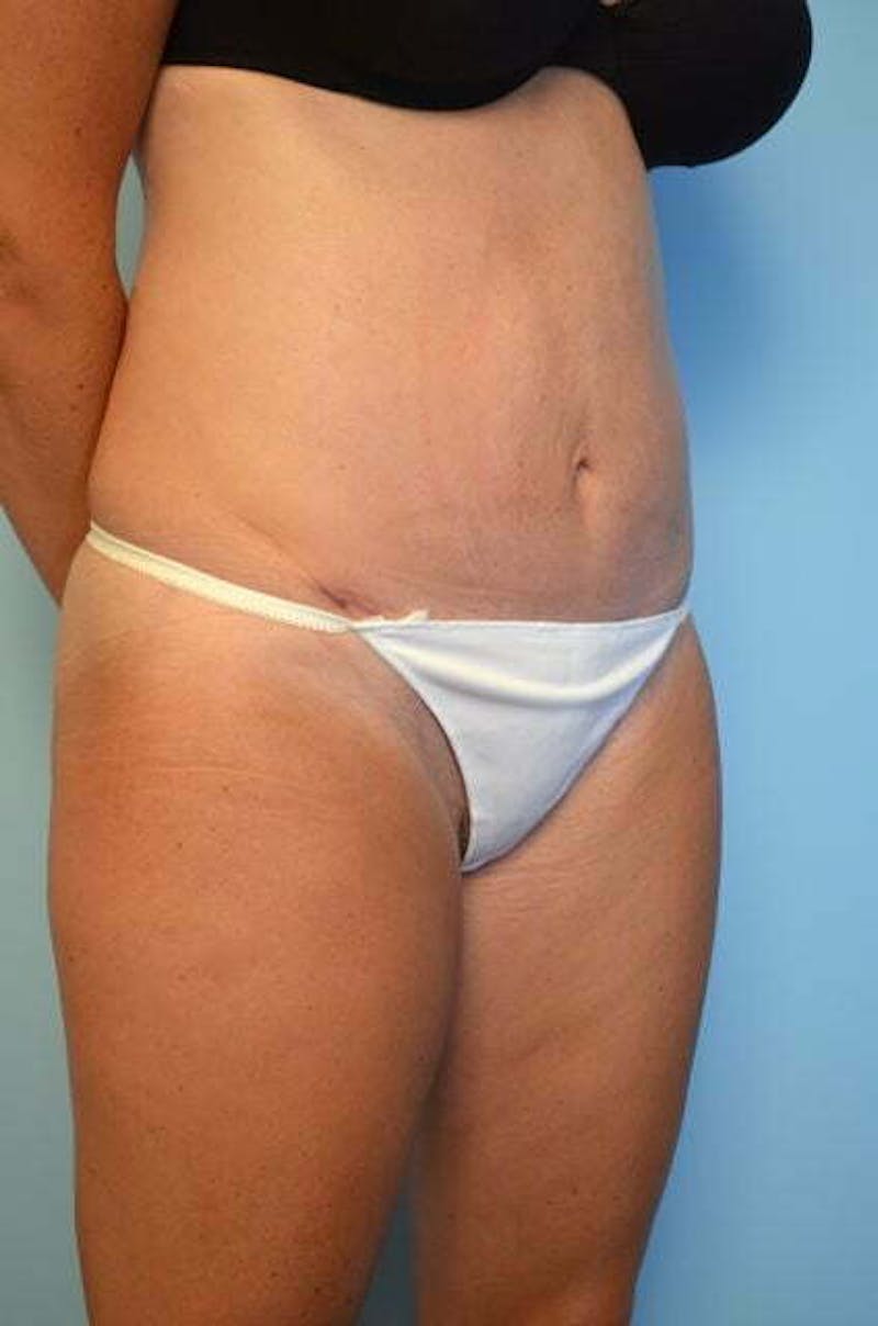 Umbilical Float Tummy Tuck Before & After Gallery - Patient 859967 - Image 4