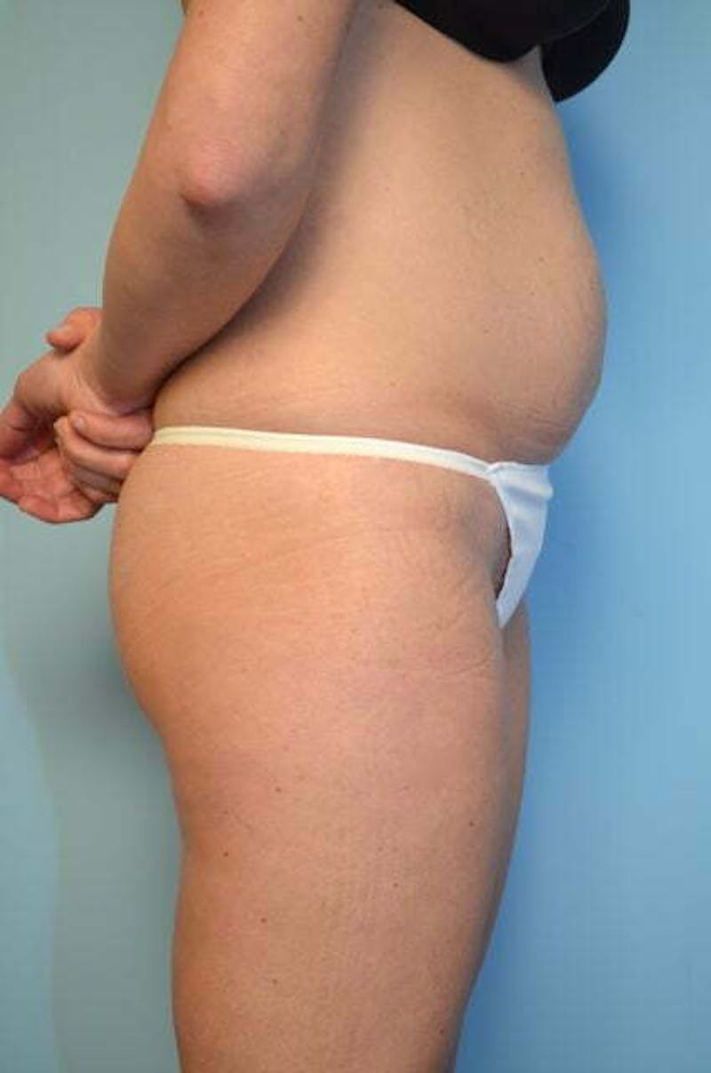 Umbilical Float Tummy Tuck Before & After Gallery - Patient 859967 - Image 5