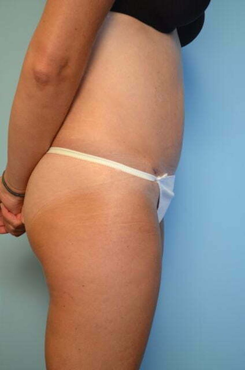Umbilical Float Tummy Tuck Before & After Gallery - Patient 859967 - Image 6