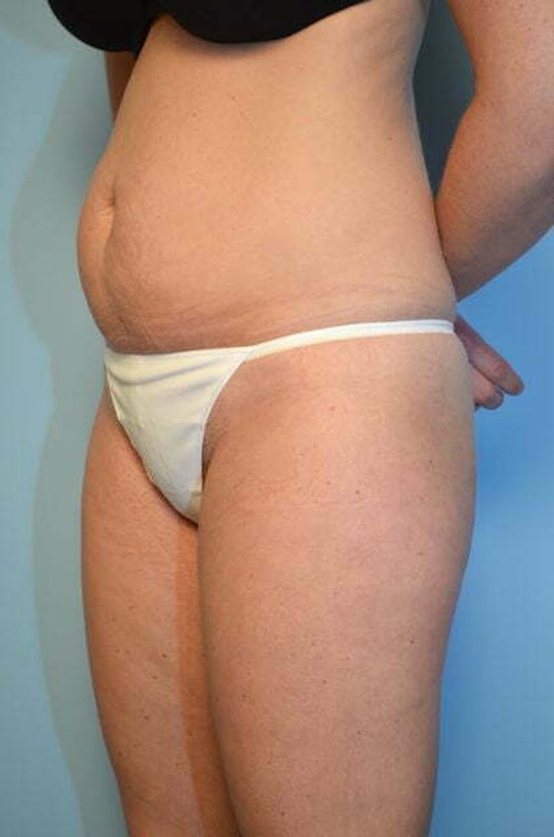 Umbilical Float Tummy Tuck Before & After Gallery - Patient 859967 - Image 7