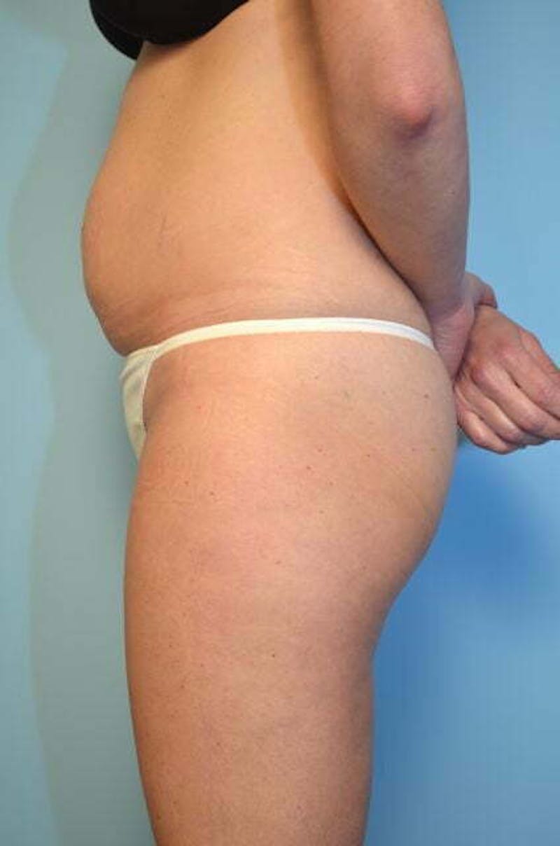 Umbilical Float Tummy Tuck Before & After Gallery - Patient 859967 - Image 9