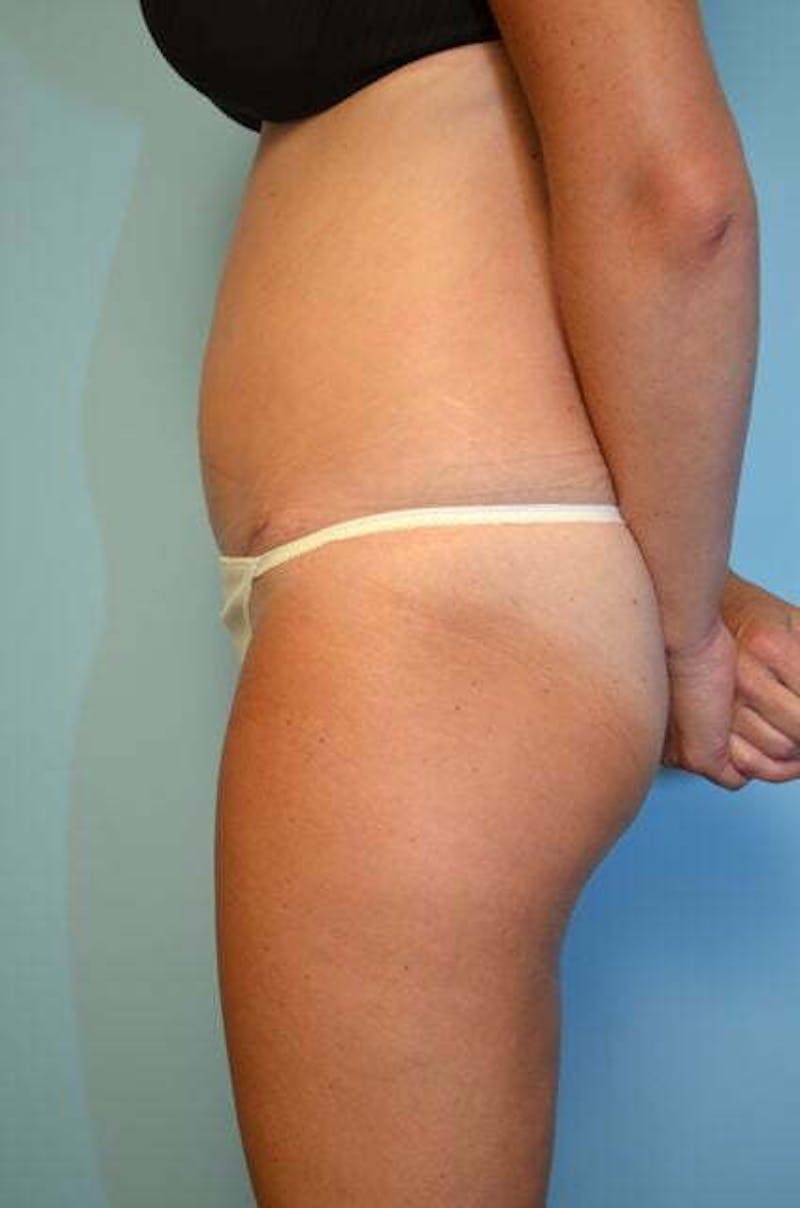 Umbilical Float Tummy Tuck Before & After Gallery - Patient 859967 - Image 10