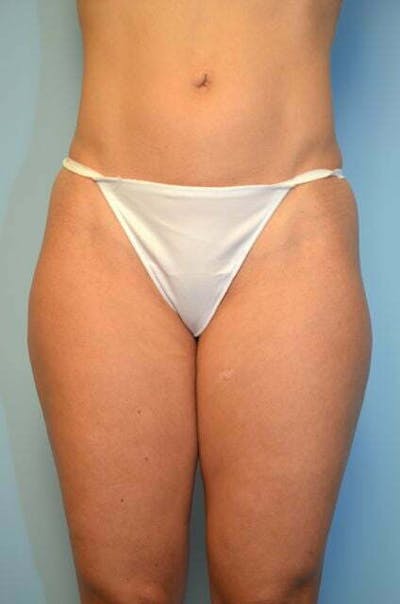 Liposuction Before & After Gallery - Patient 424104 - Image 1