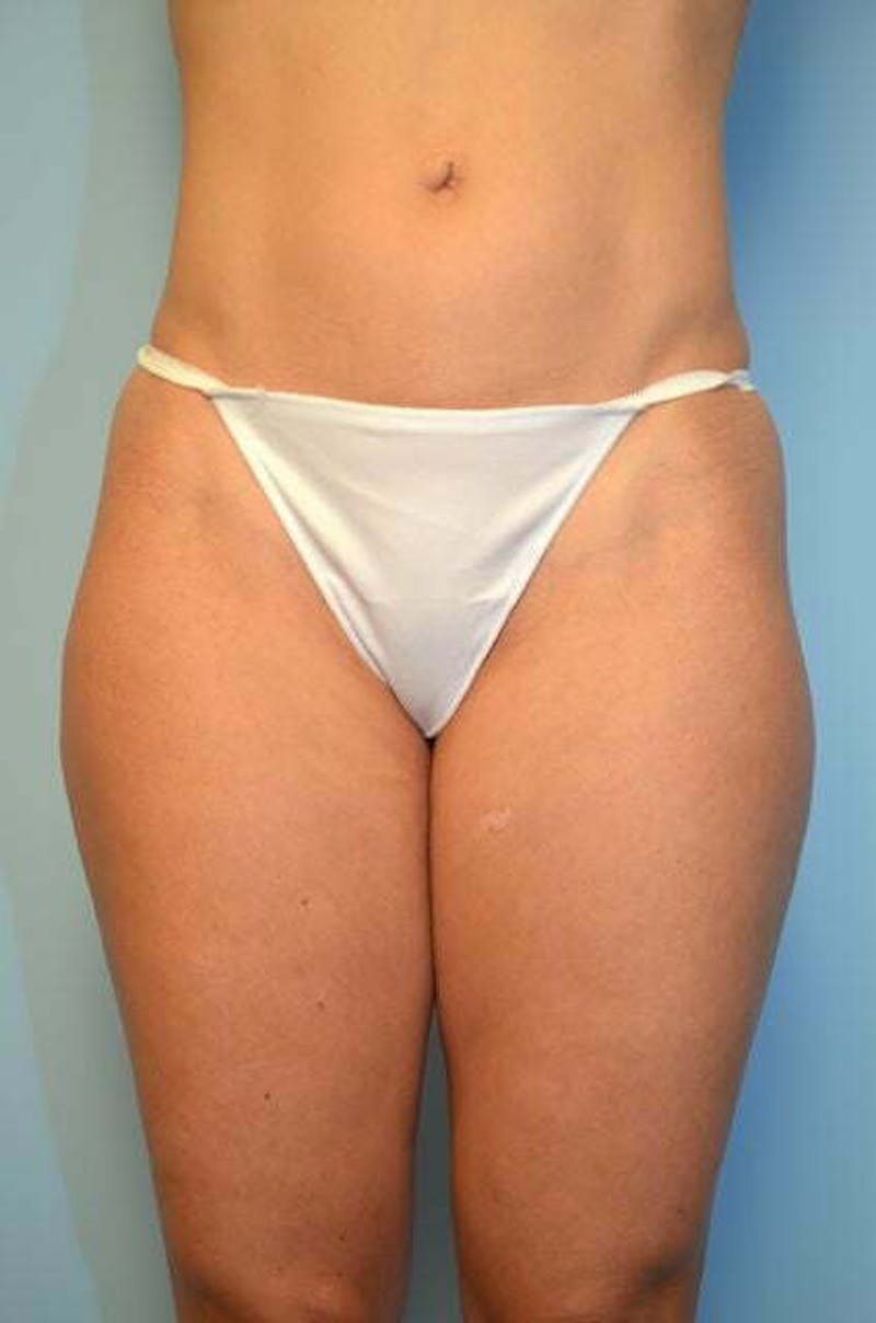 Liposuction Before & After Gallery - Patient 424104 - Image 1