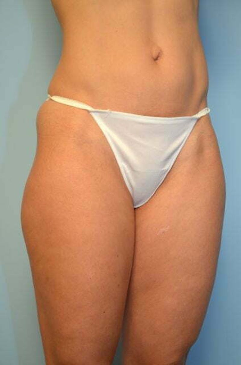 Liposuction Before & After Gallery - Patient 424104 - Image 3