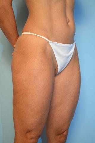 Liposuction Before & After Gallery - Patient 424104 - Image 4