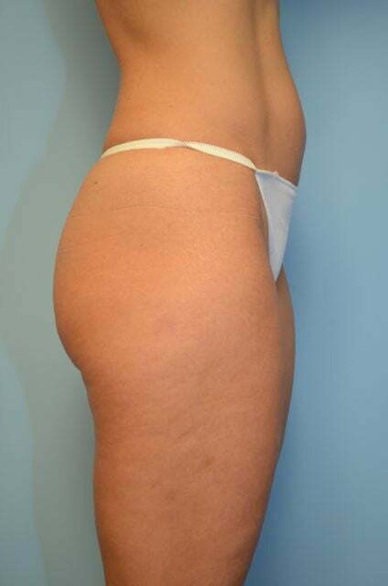 Liposuction Before & After Gallery - Patient 424104 - Image 5