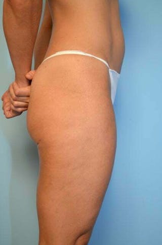 Liposuction Before & After Gallery - Patient 424104 - Image 6