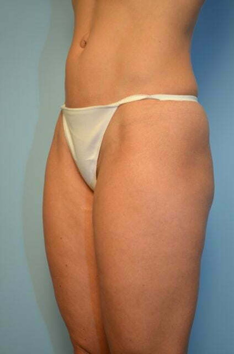 Liposuction Before & After Gallery - Patient 424104 - Image 7