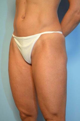 Liposuction Before & After Gallery - Patient 424104 - Image 8