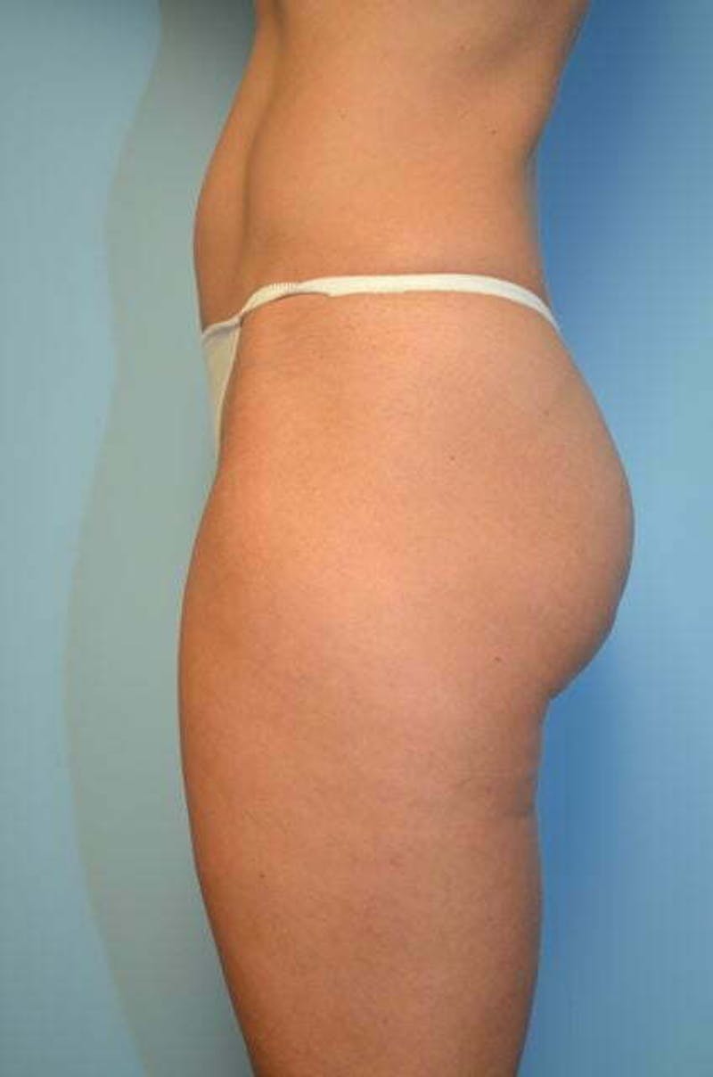 Liposuction Before & After Gallery - Patient 424104 - Image 9